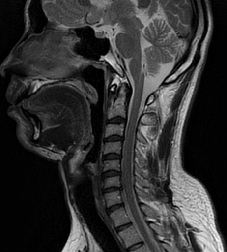 頸椎MRI